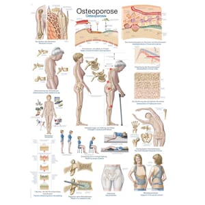 Plakat anatomisk "Osteoporose" 70x100cm
